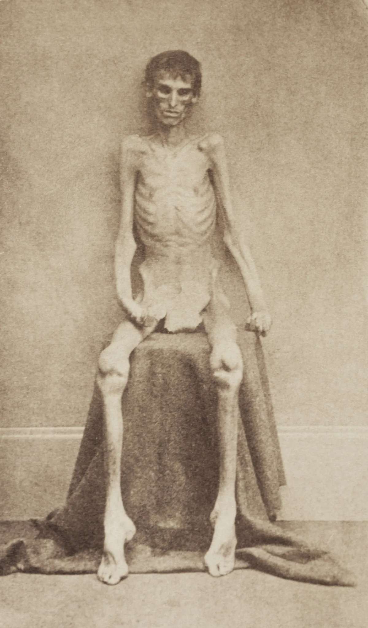 A stark sepia portrait shows an emaciated Civil War prisoner seated on a draped stool, his ribs and bones sharply visible against a plain studio backdrop. The figure is centered and front-facing, with the aged photograph’s soft blur and warm brown tone emphasizing its historical, somber mood.